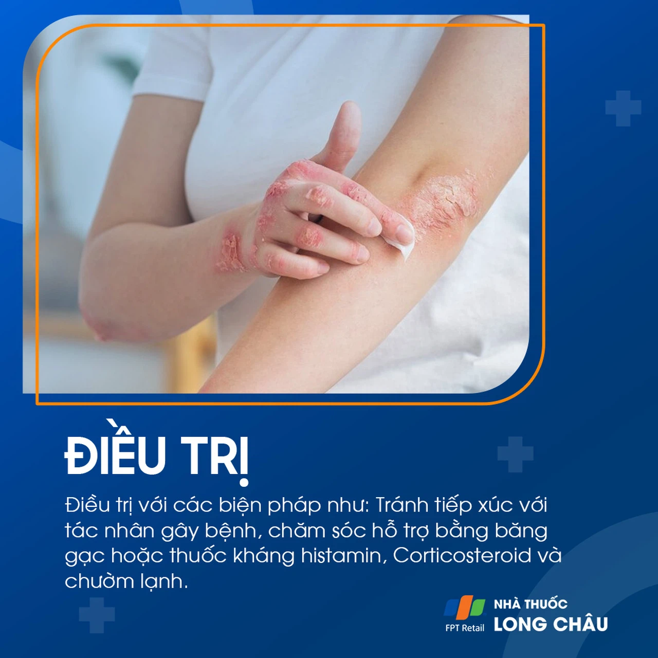 Điều trị viêm da do tiếp xúc bằng kem chống viêm và thuốc bôi giảm ngứa