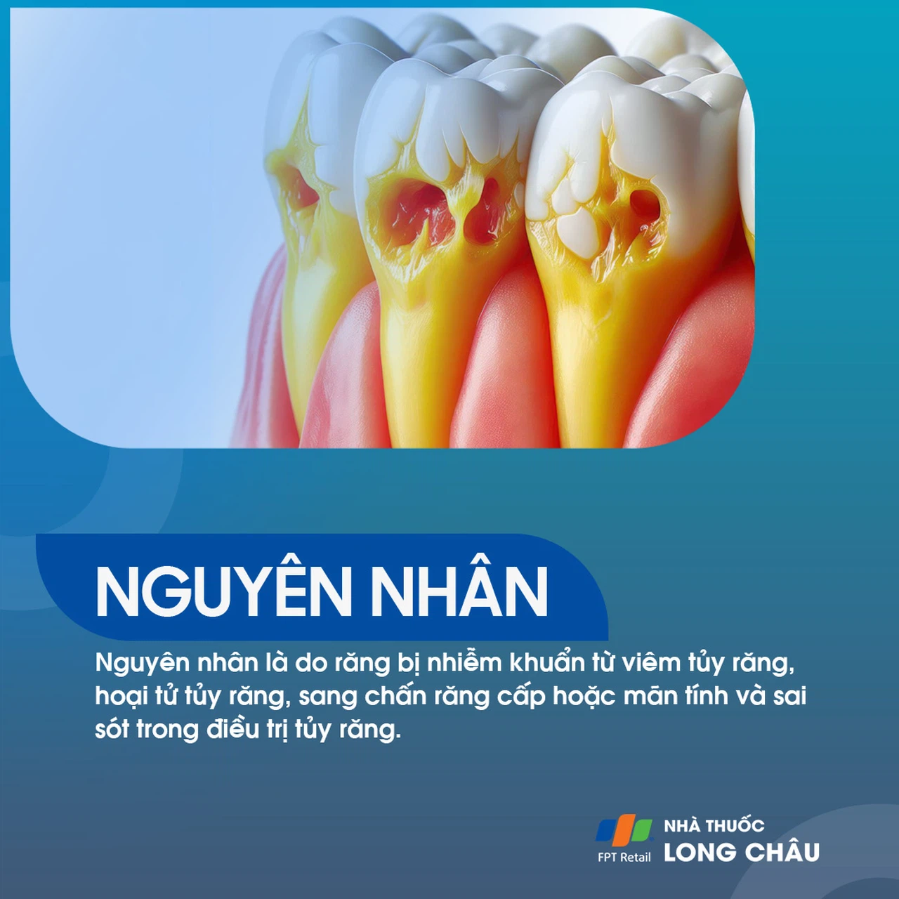 Viêm quanh răng 3