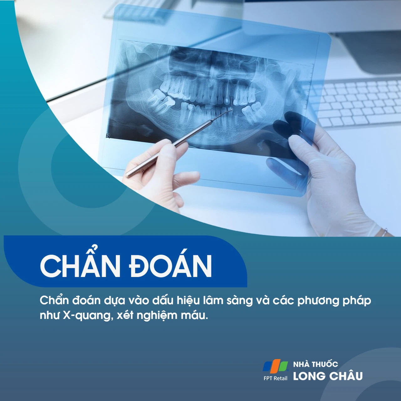 Viêm quanh răng 5