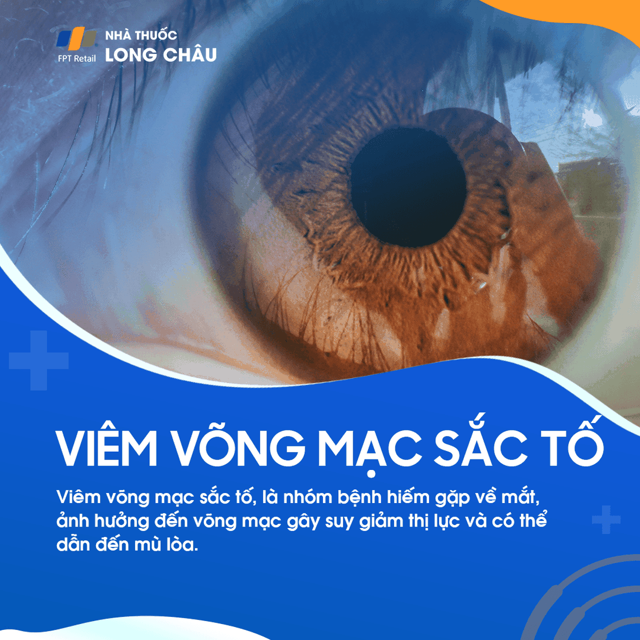 Viêm võng mạc sắc tố 1