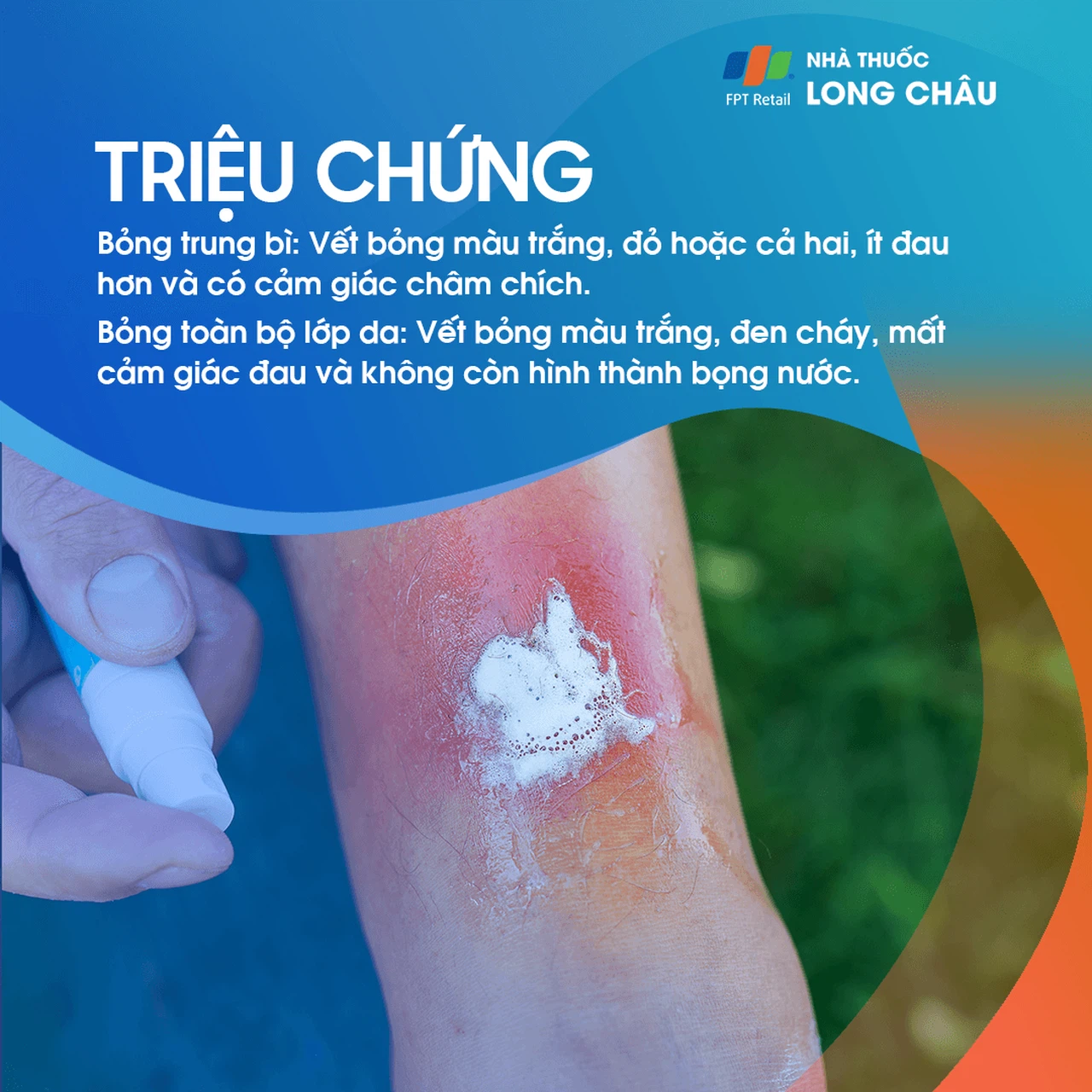 Bỏng da 2