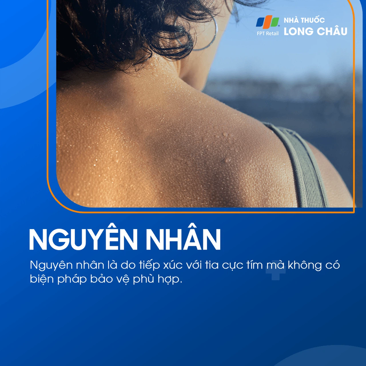 Bỏng nắng 3