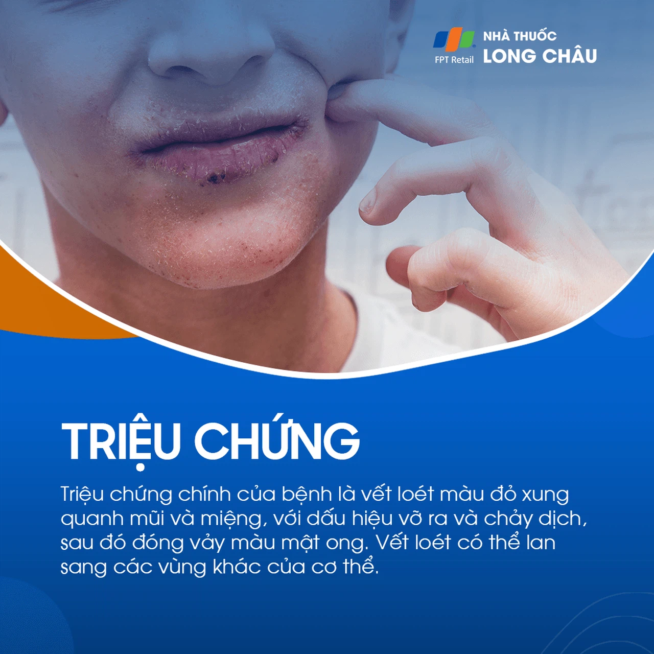 Chốc lở 2