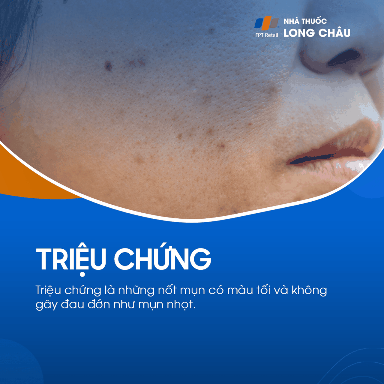 Mụn Đầu Đen 2
