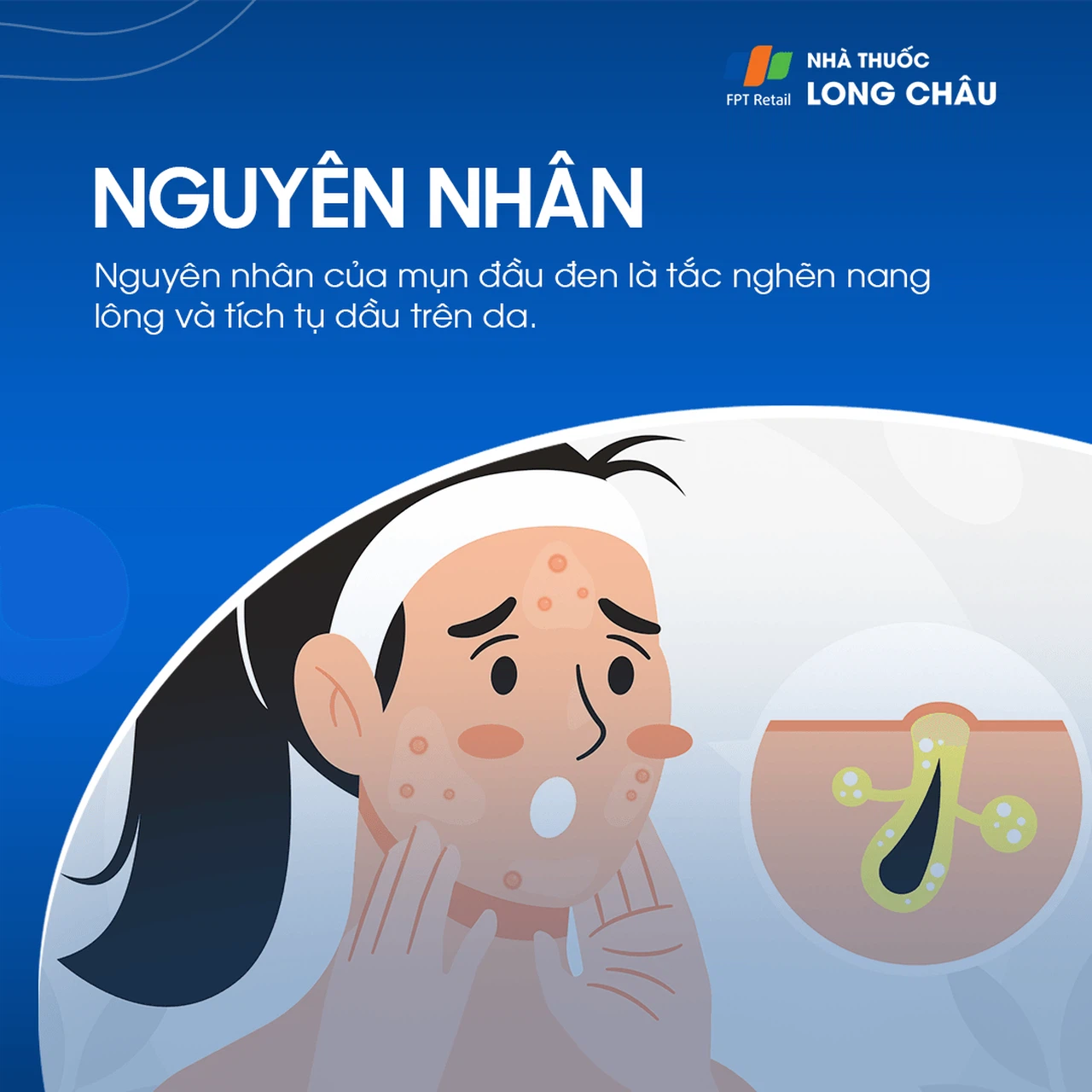 Mụn Đầu Đen 3