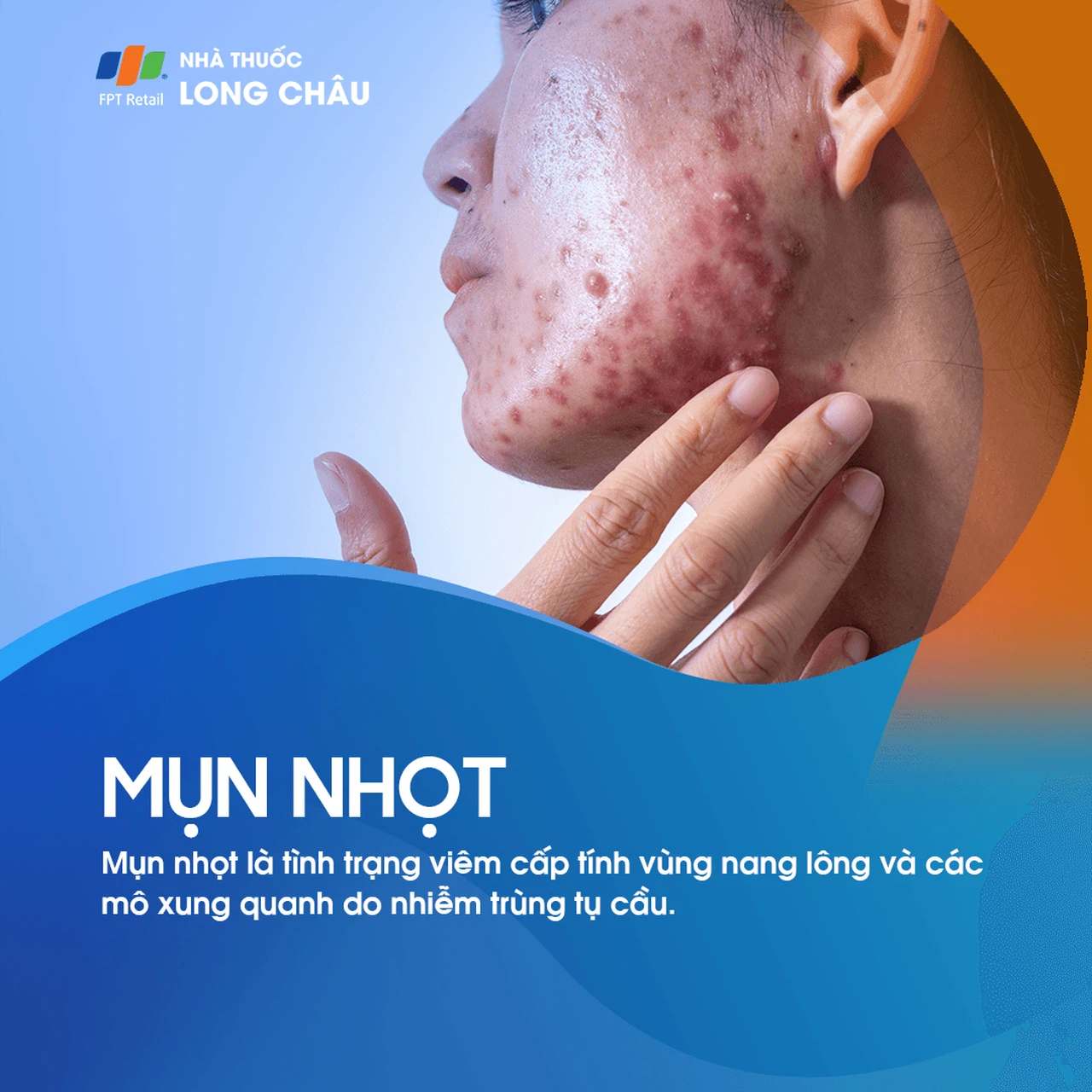 Mụn Nhọt 1