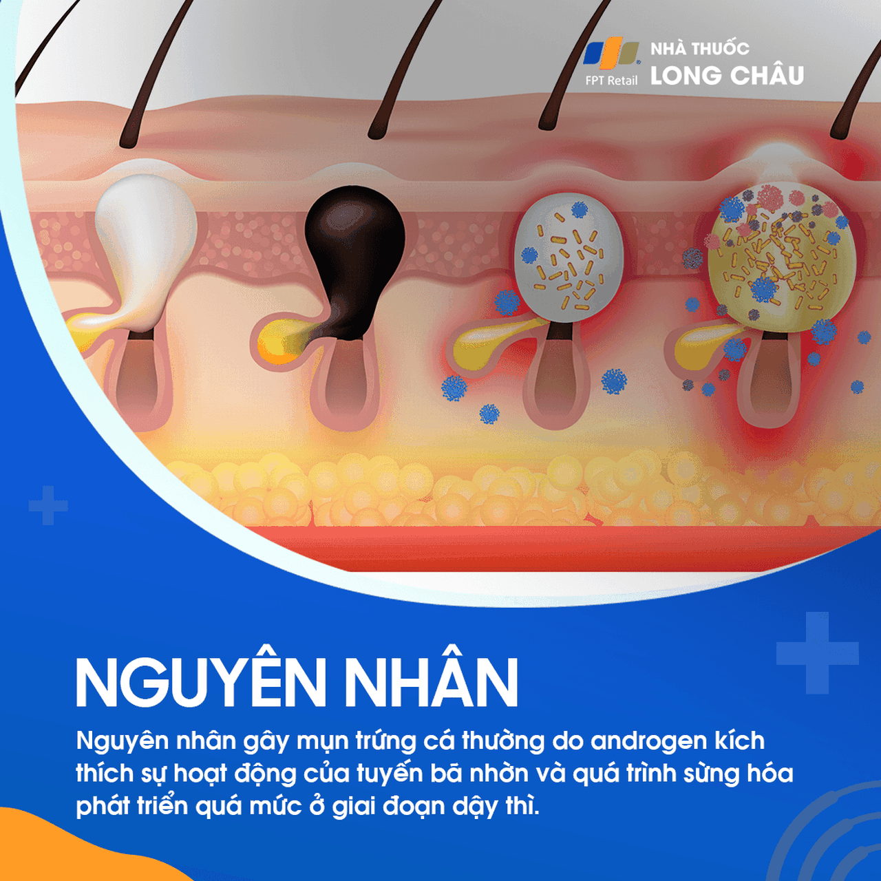 Mụn trứng cá 3
