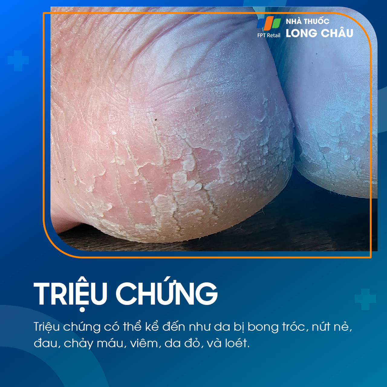Nứt Gót Chân 2
