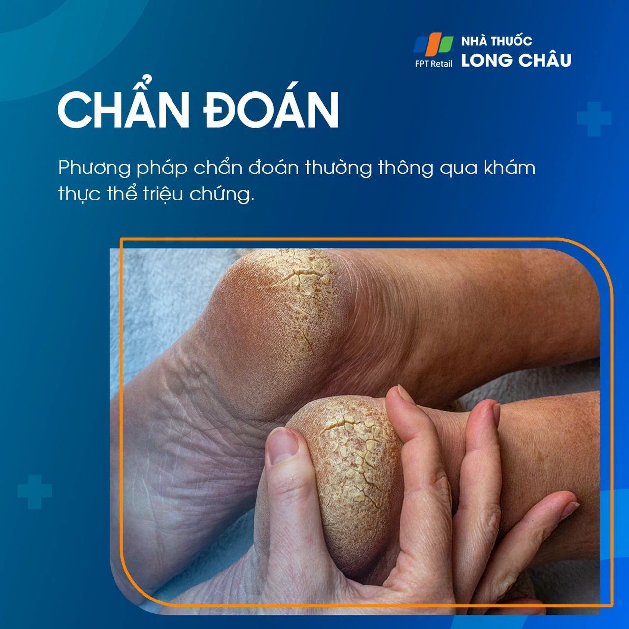 Nứt Gót Chân 5