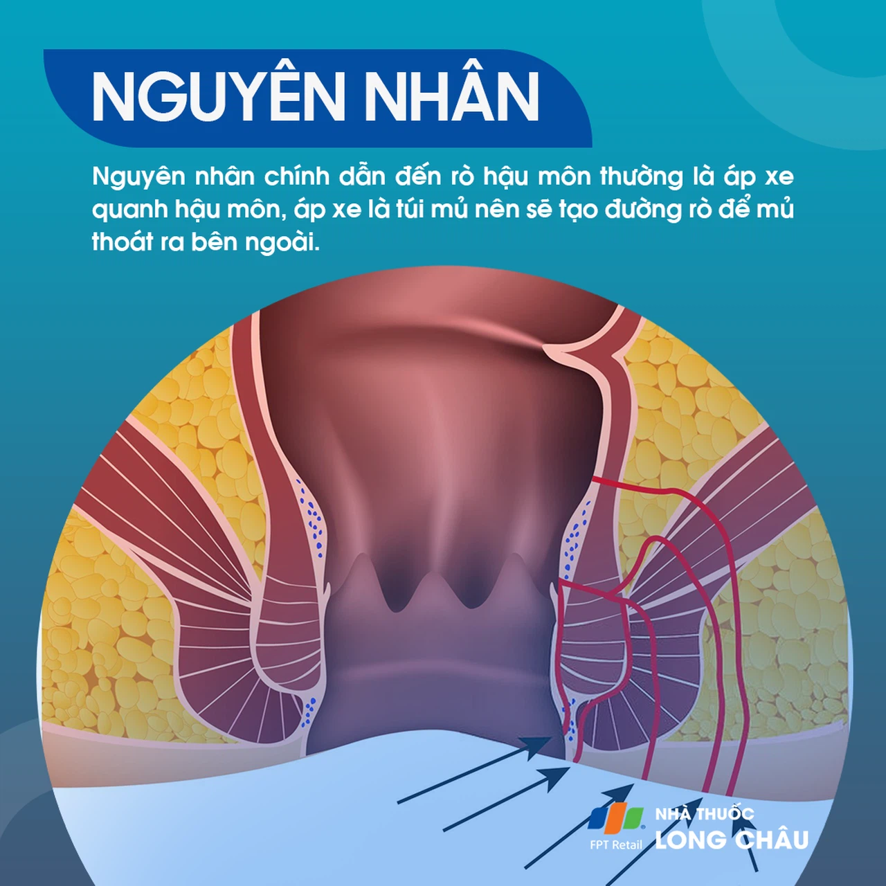Rò hậu môn 3