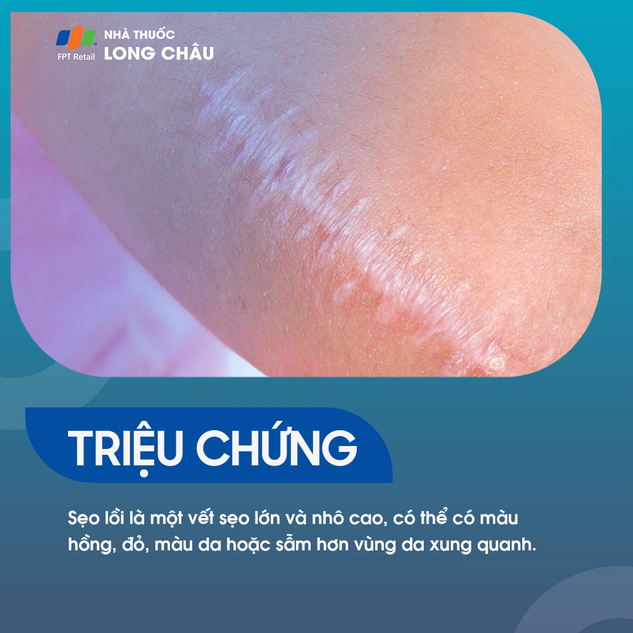 Sẹo Lồi 2