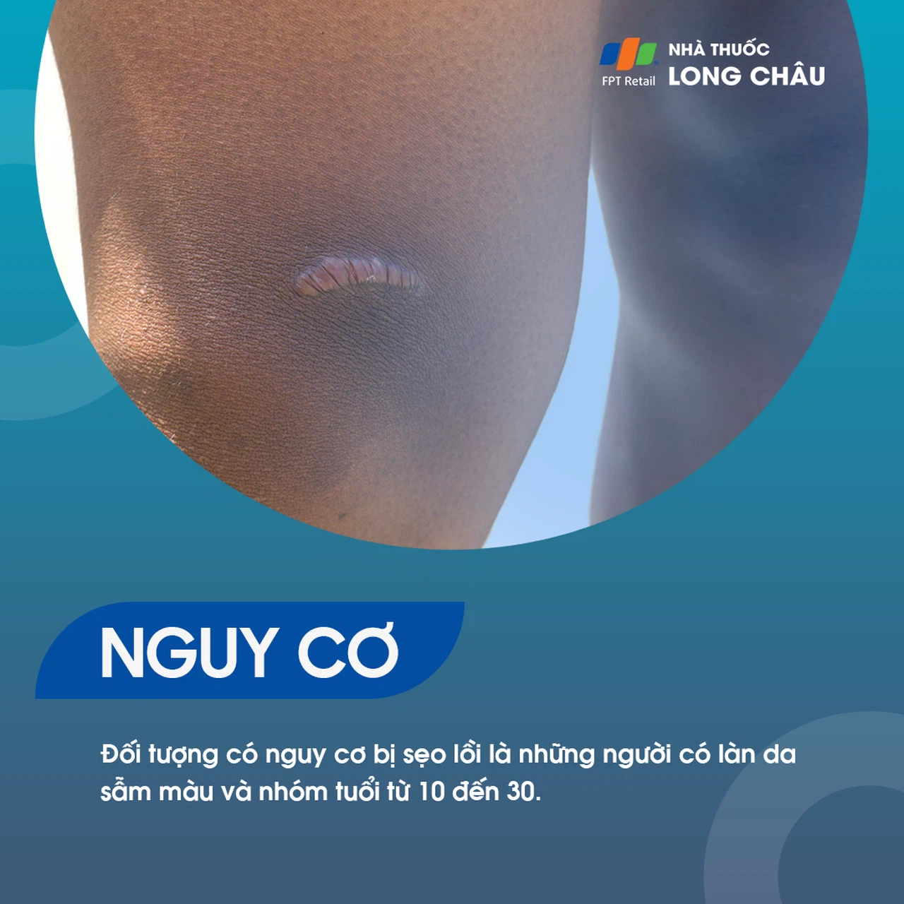 Sẹo Lồi 4