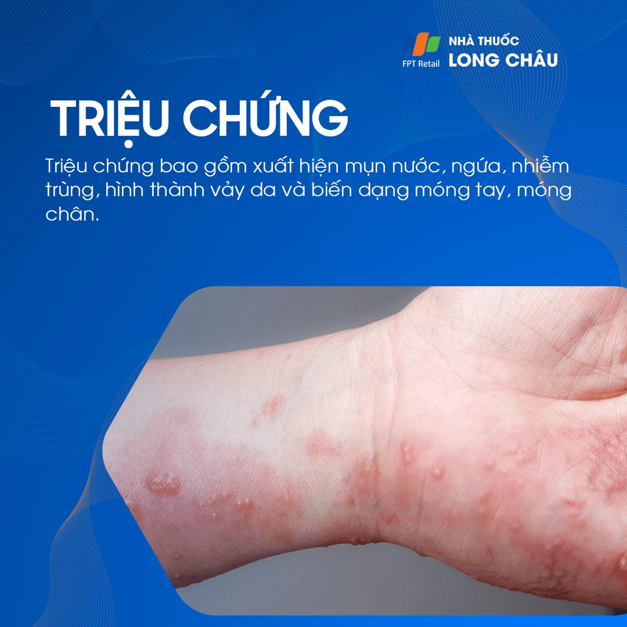 Triệu chứng bệnh tổ đỉa bao gồm đỏ da, ngứa ngáy, và xuất hiện các mảng da khô, vảy nến