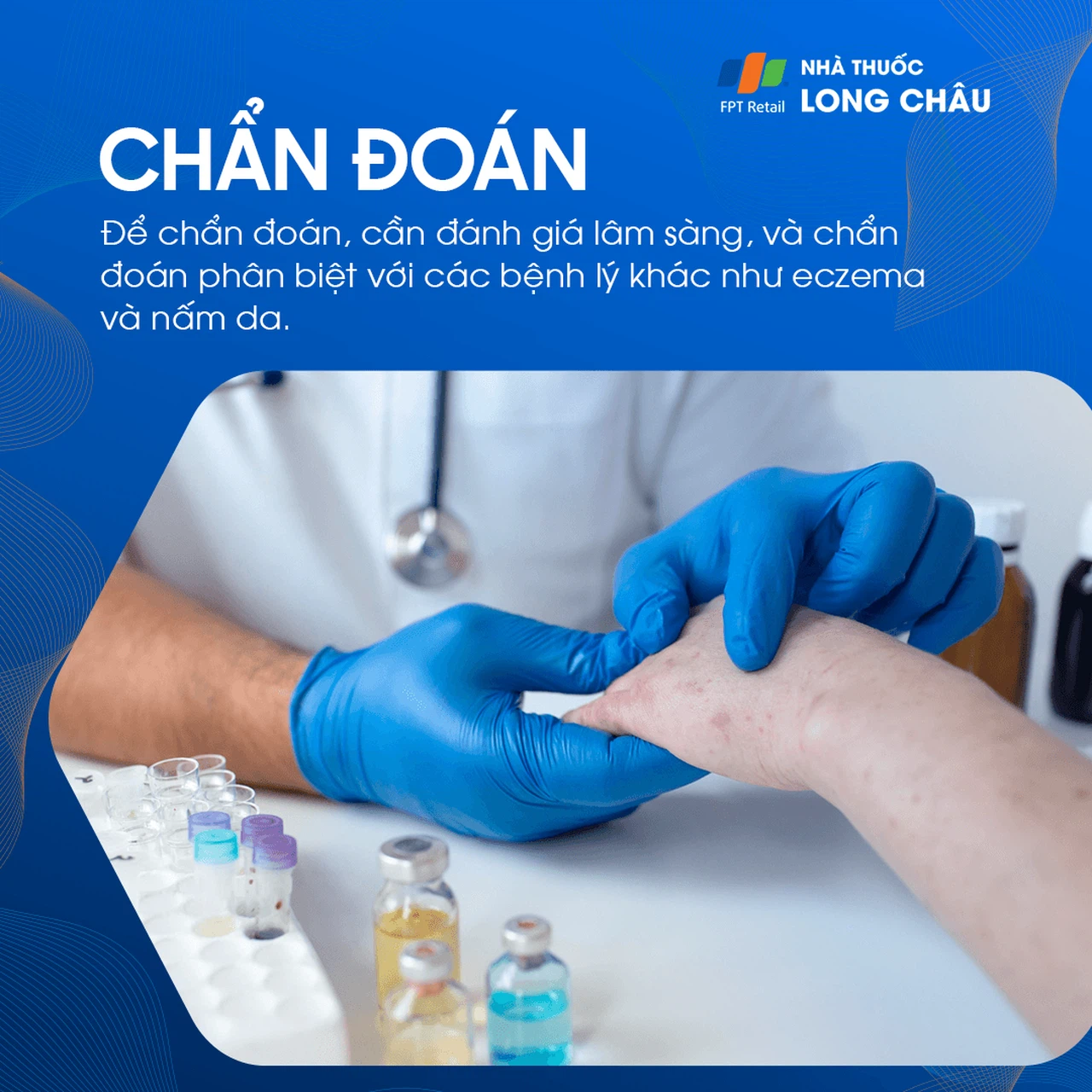 Chẩn đoán bệnh tổ đỉa thông qua khám lâm sàng và có thể yêu cầu làm các xét nghiệm