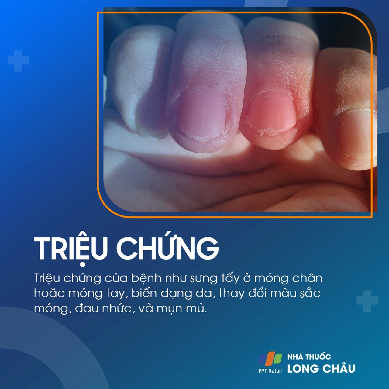 Viêm Quanh Móng 2