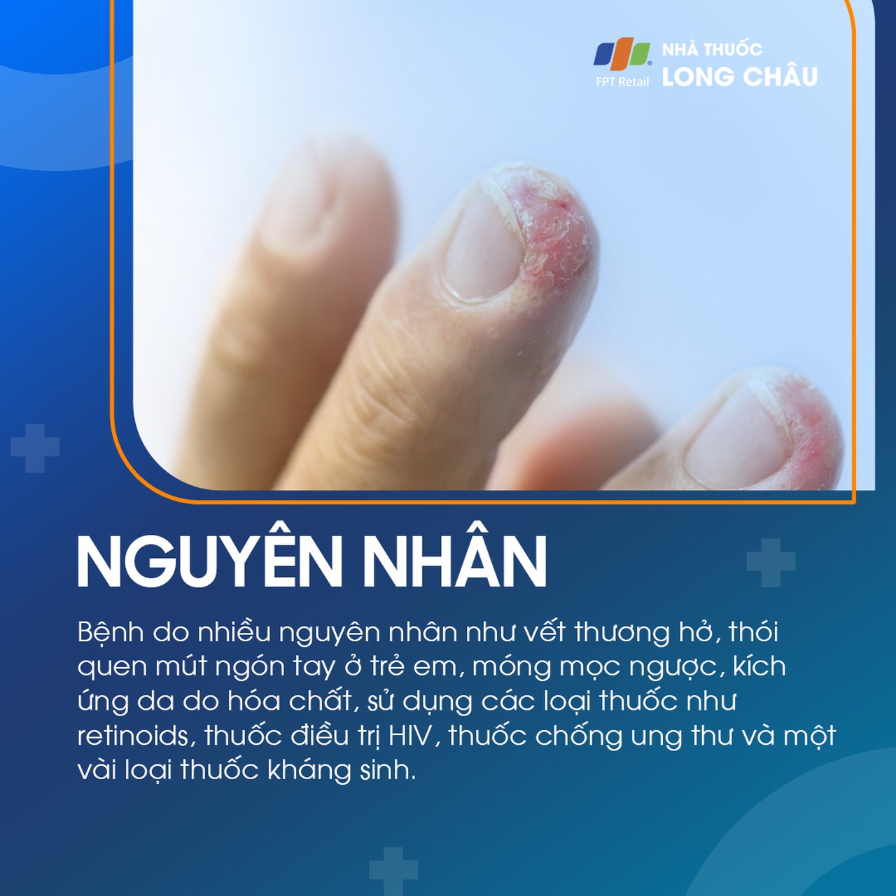 Viêm Quanh Móng 3