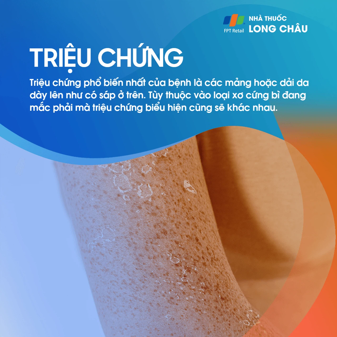 Xơ Cứng Bì 2