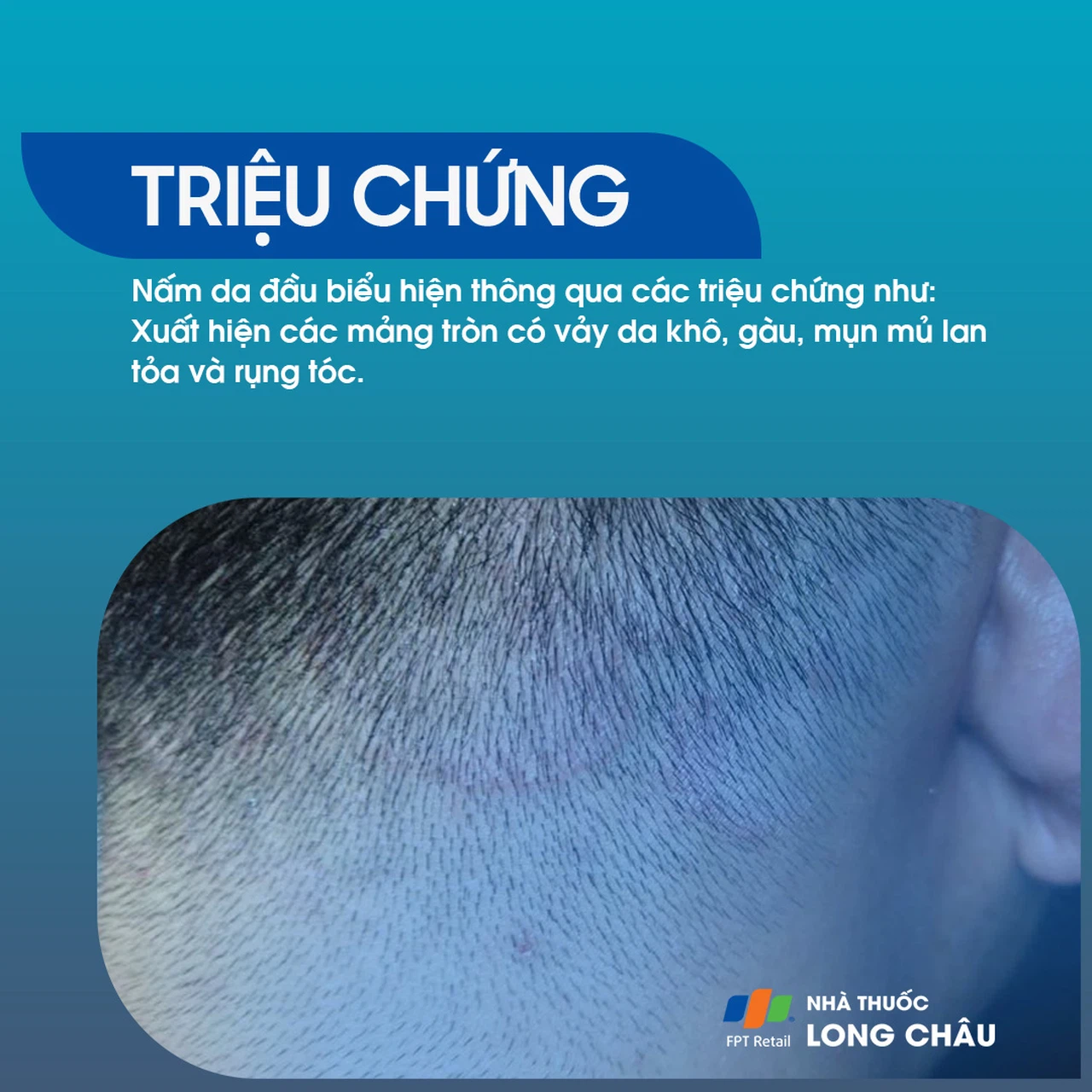 Nấm Da Đầu 2