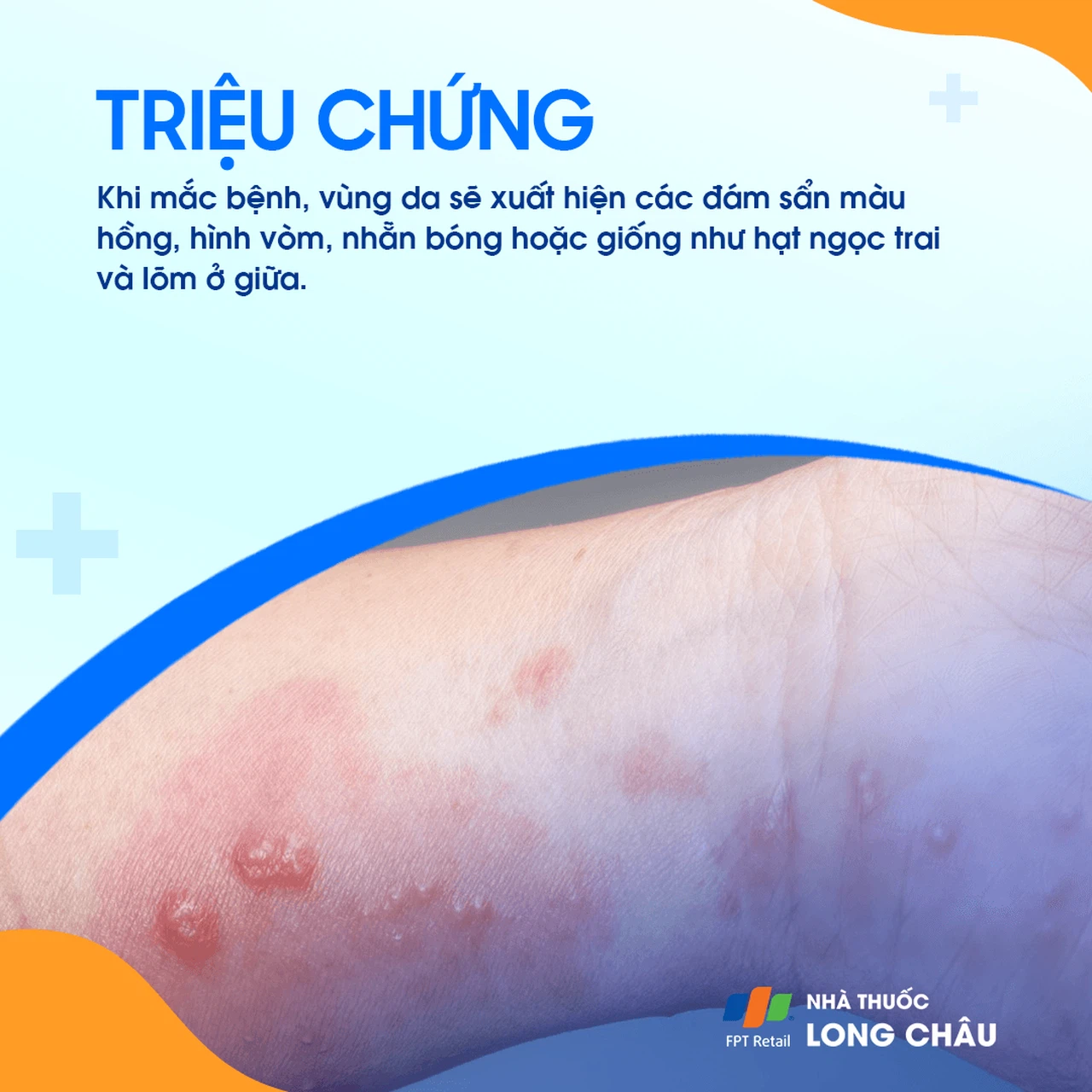U mềm lây 2