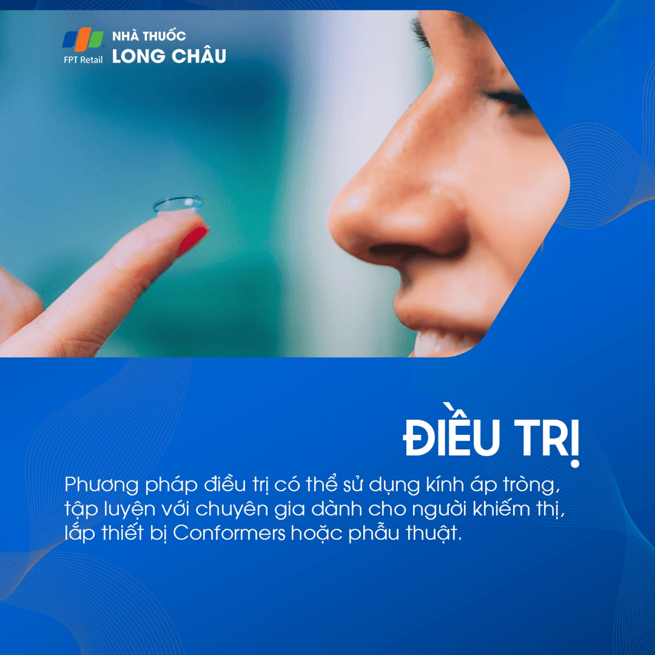 Tật mắt nhỏ 6