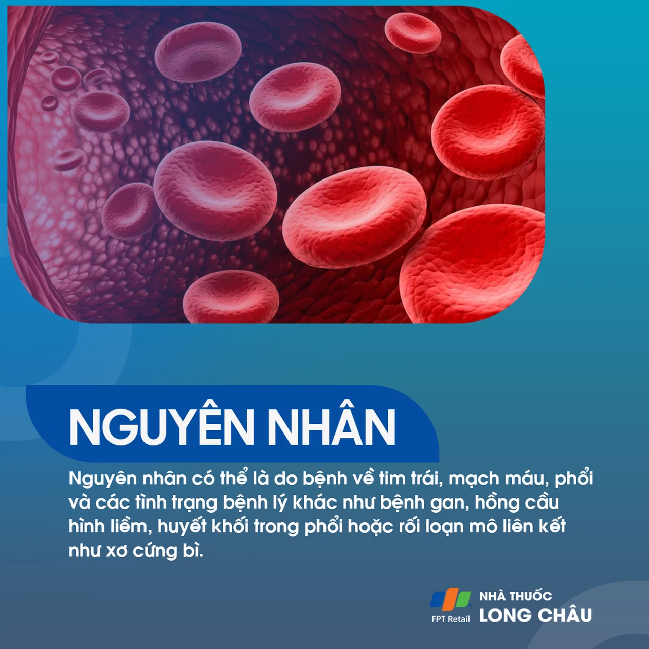 Tăng áp phổi 3