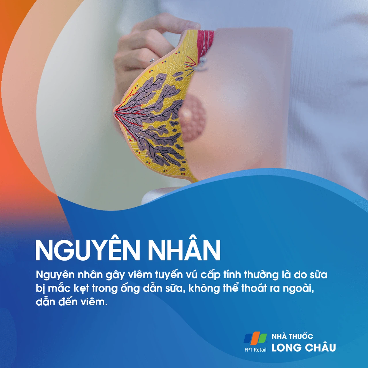 Viêm tuyến vú 2