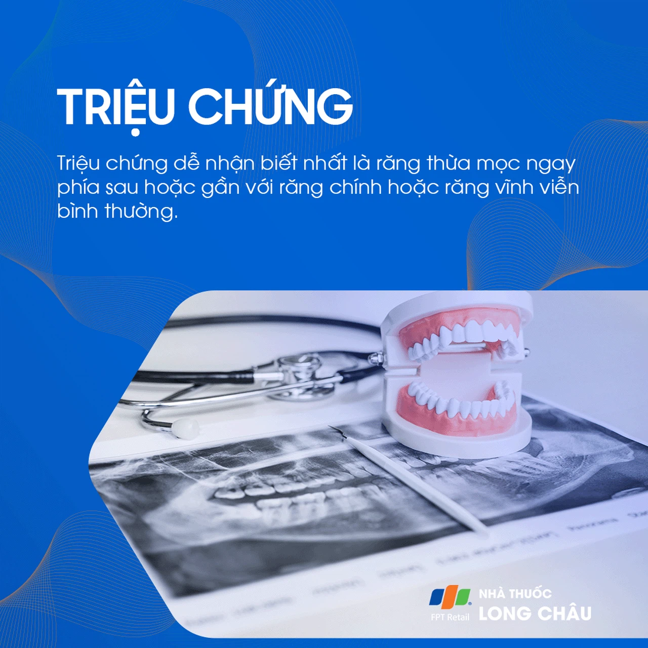 Răng thừa 2