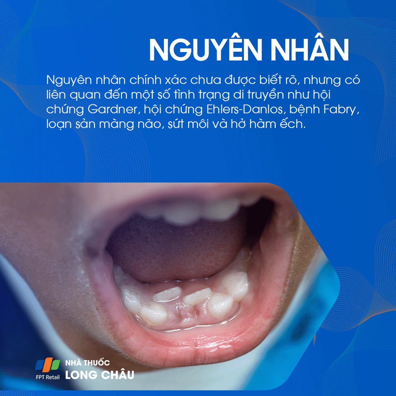 Răng thừa 3