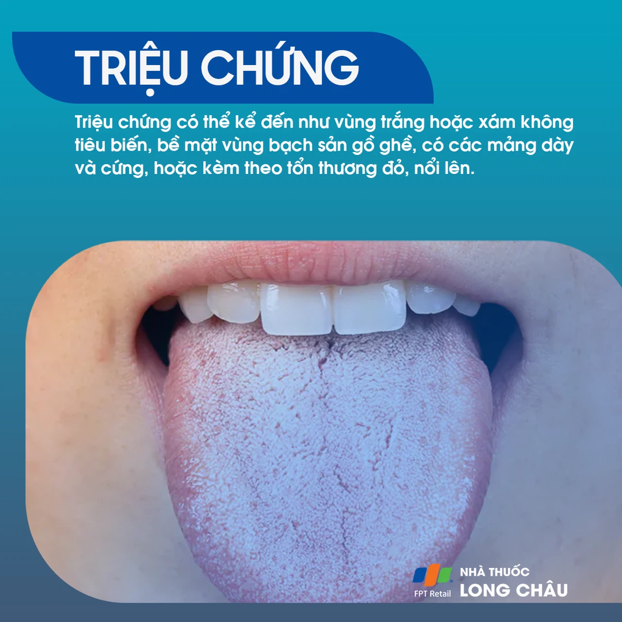 Bạch sản 2
