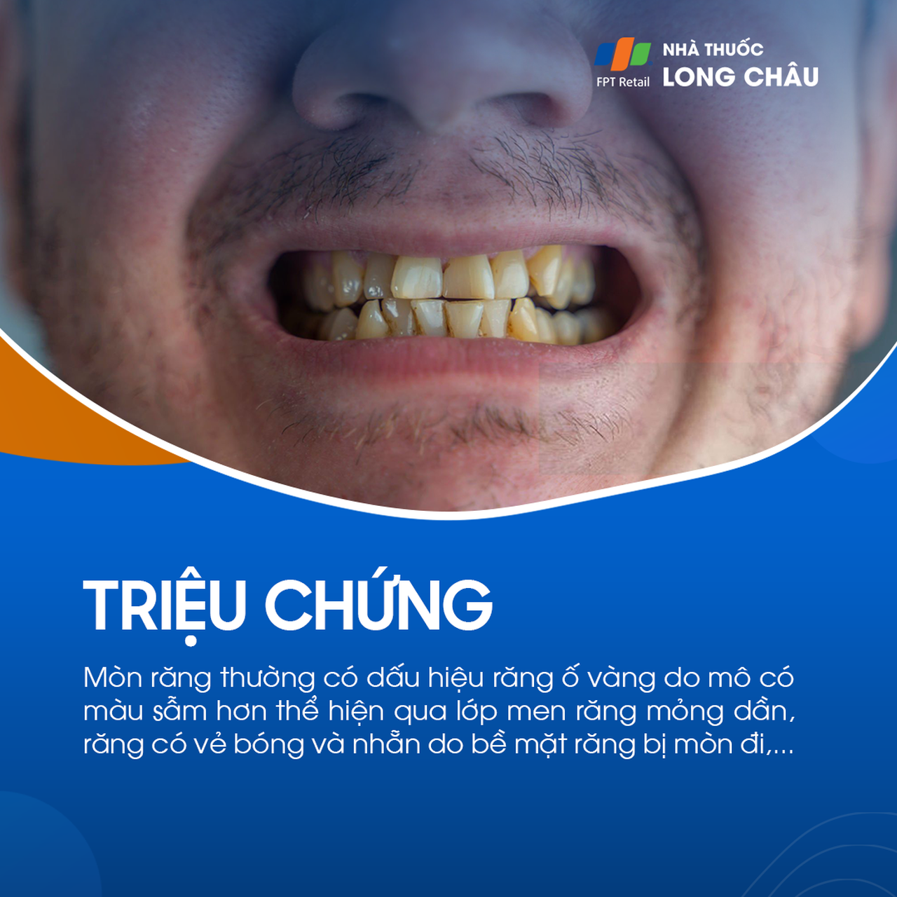 Mòn răng 2