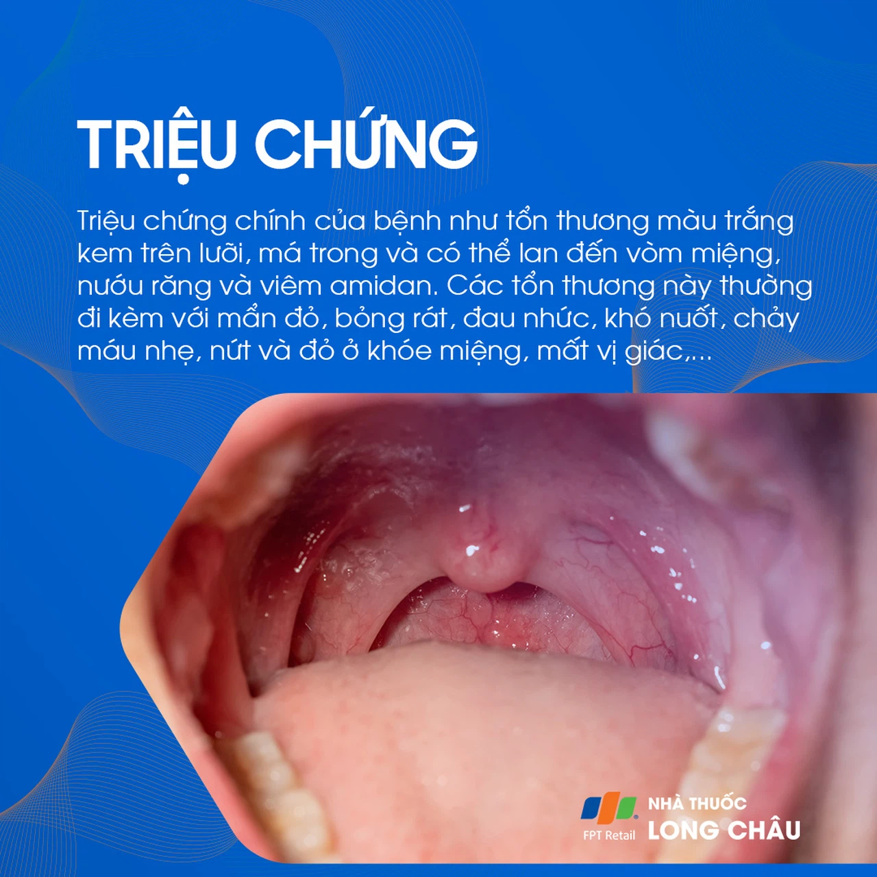 Nấm miệng 2