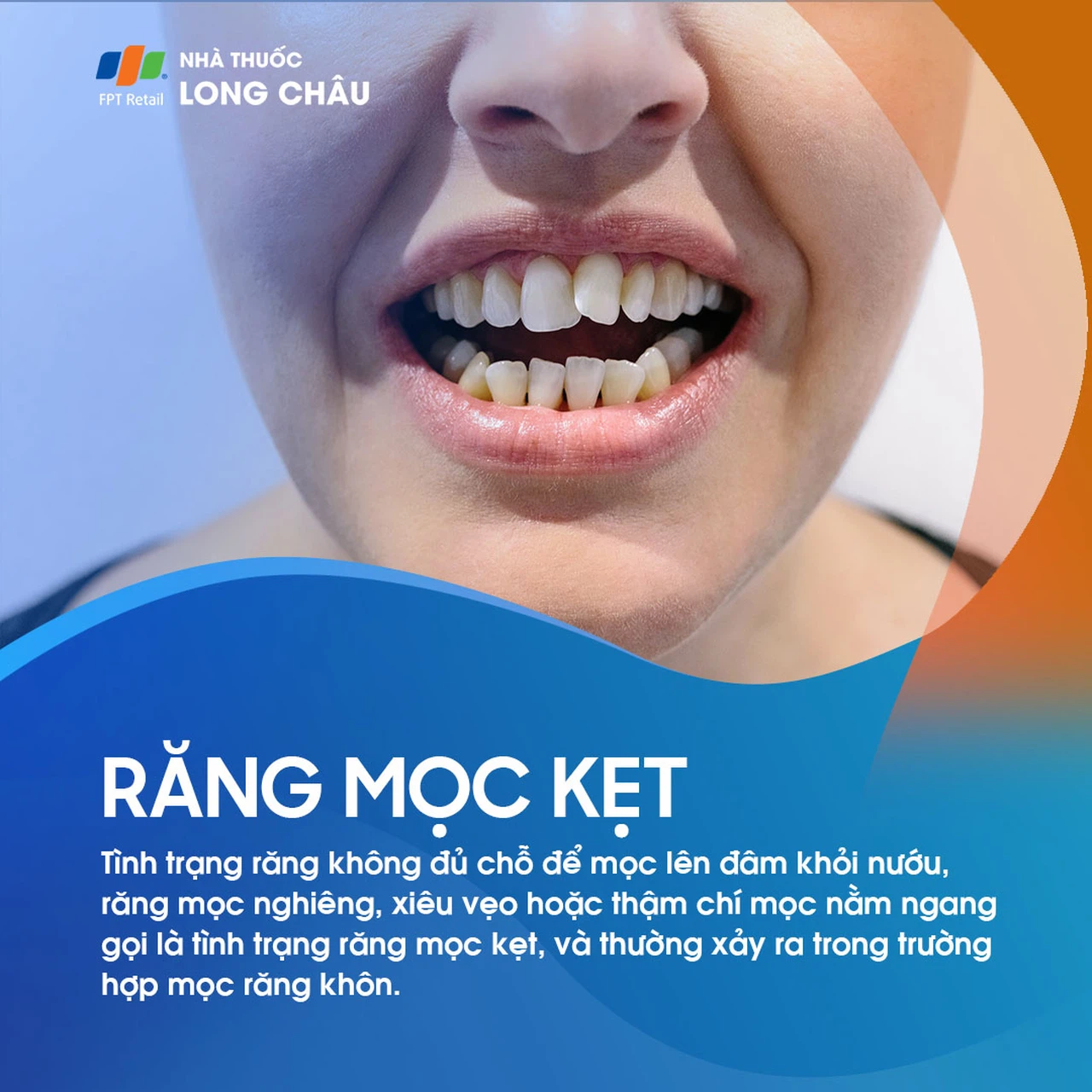Răng mọc kẹt 1