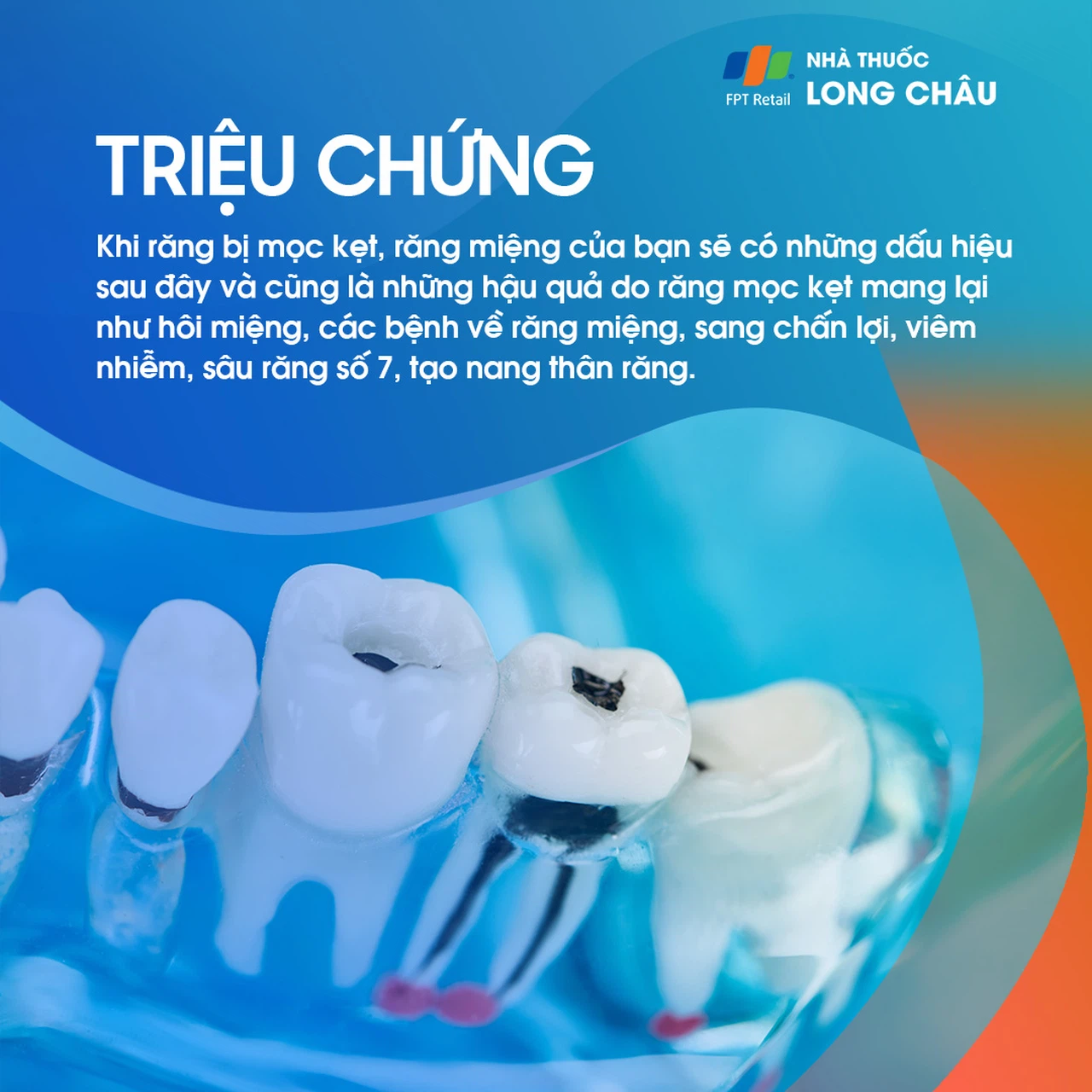 Răng mọc kẹt 2