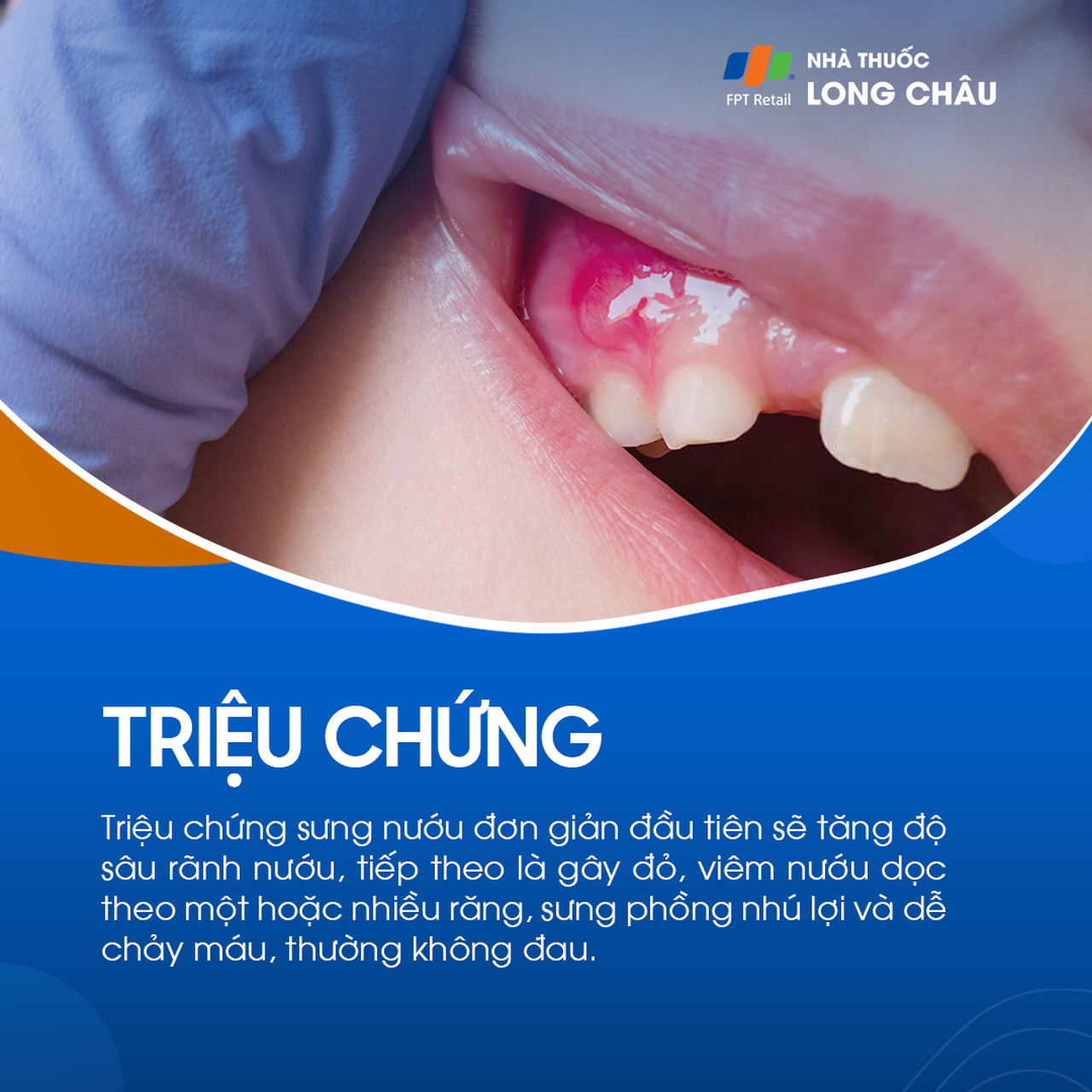 Sưng nướu 2