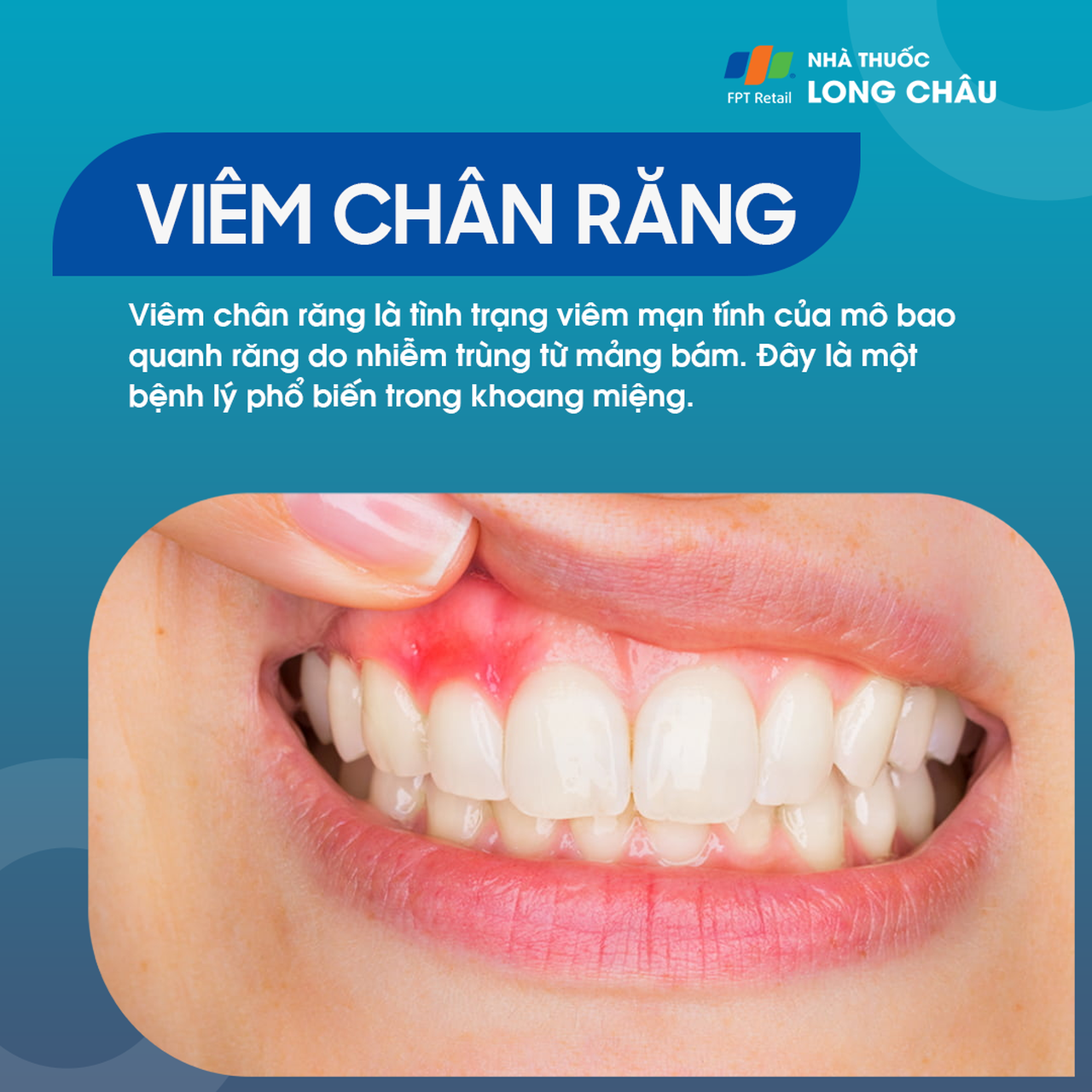 Viêm chân răng 1