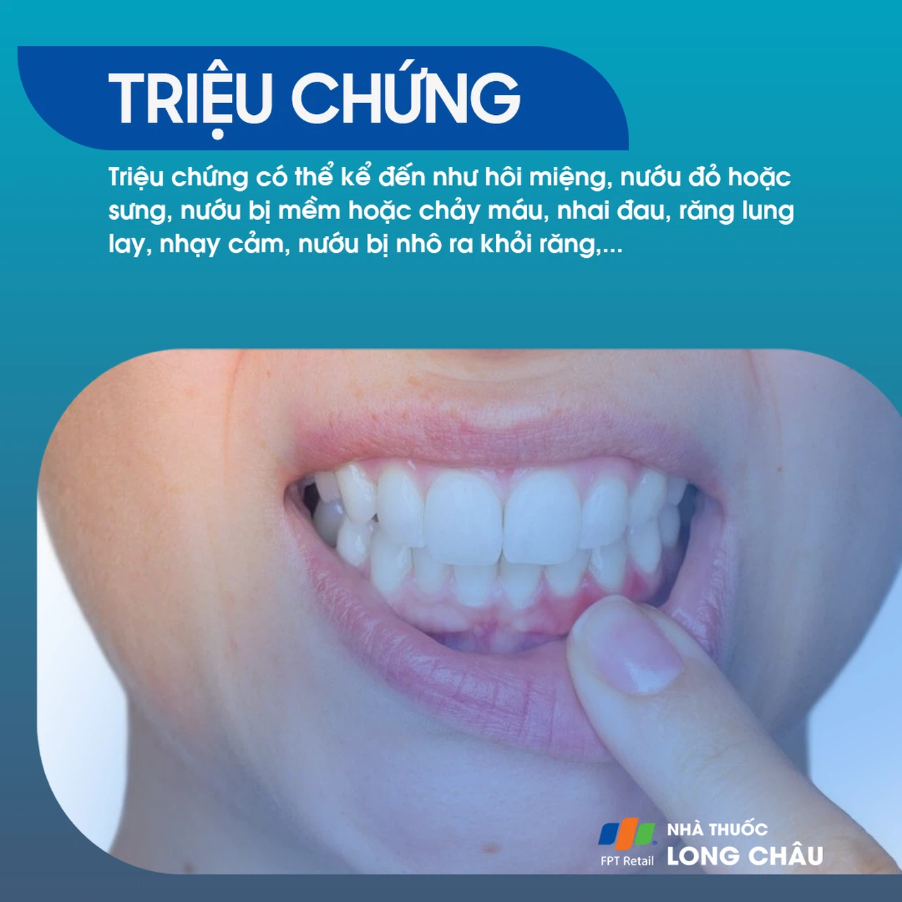 Viêm chân răng 2