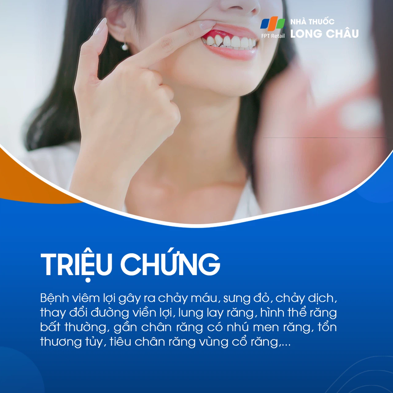 Viêm lợi 2