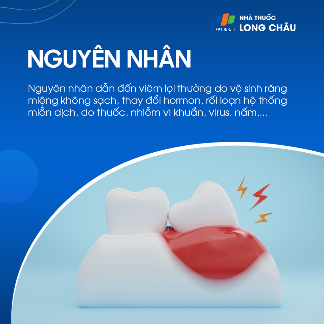 Viêm lợi 3