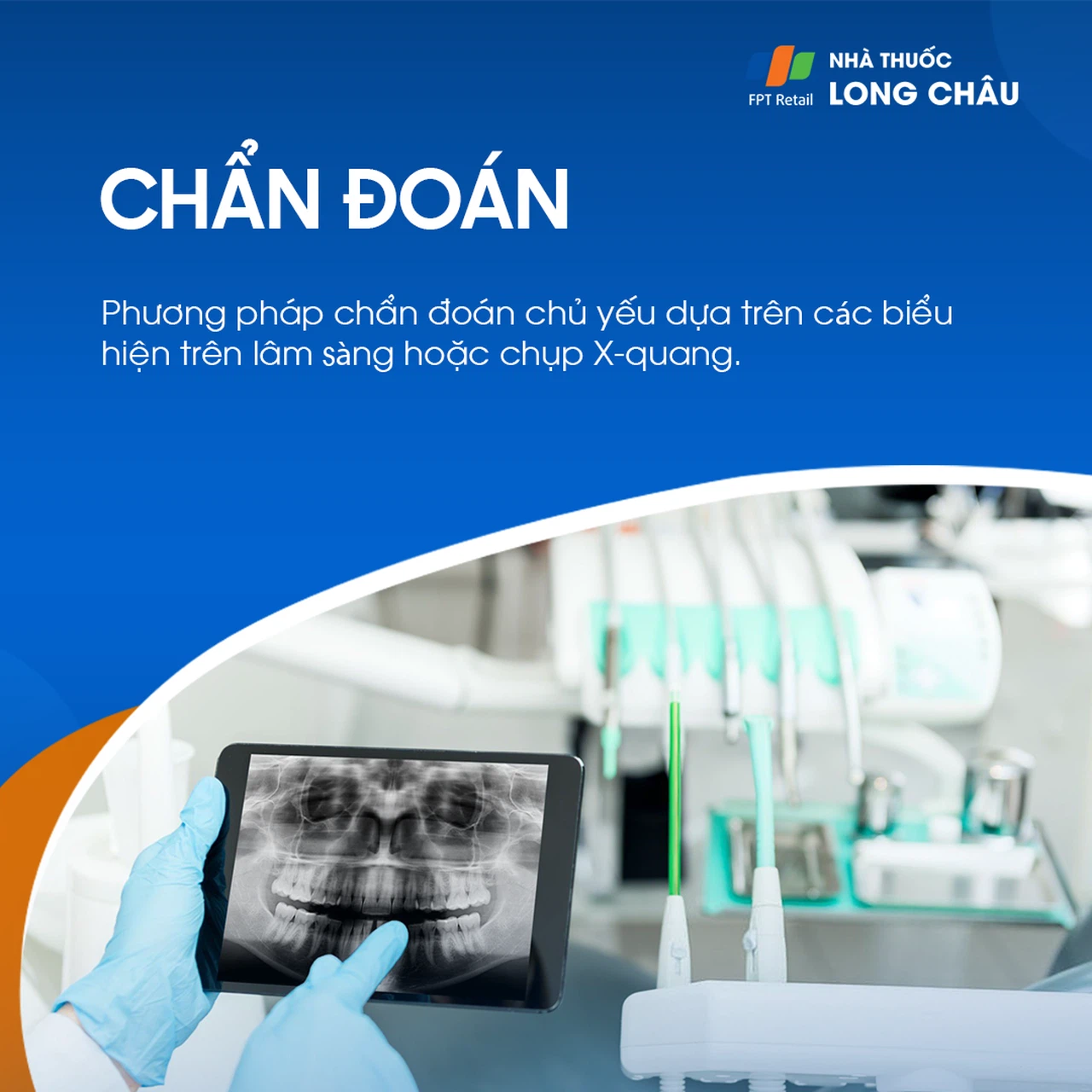 Viêm lợi 5