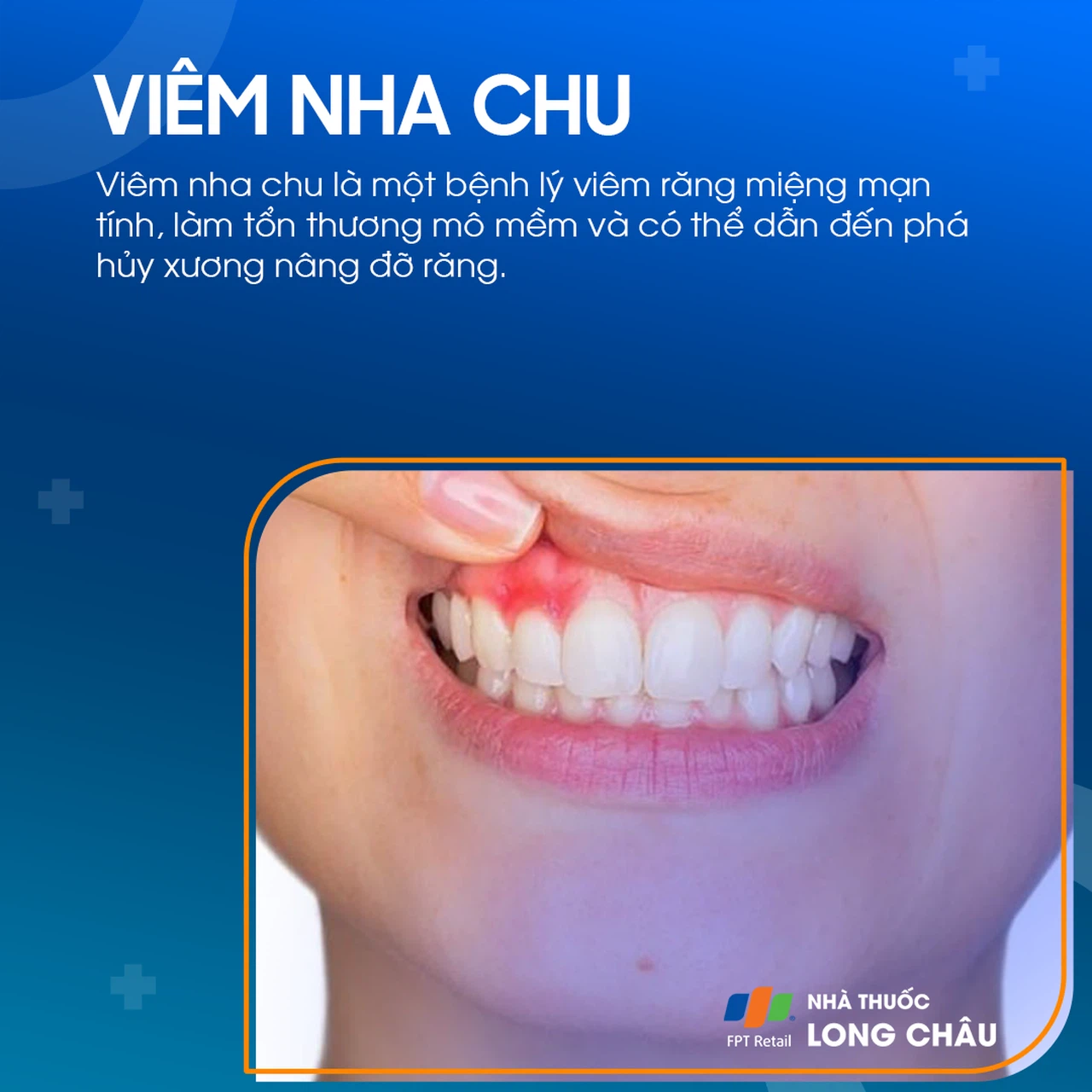 Viêm nha chu 1