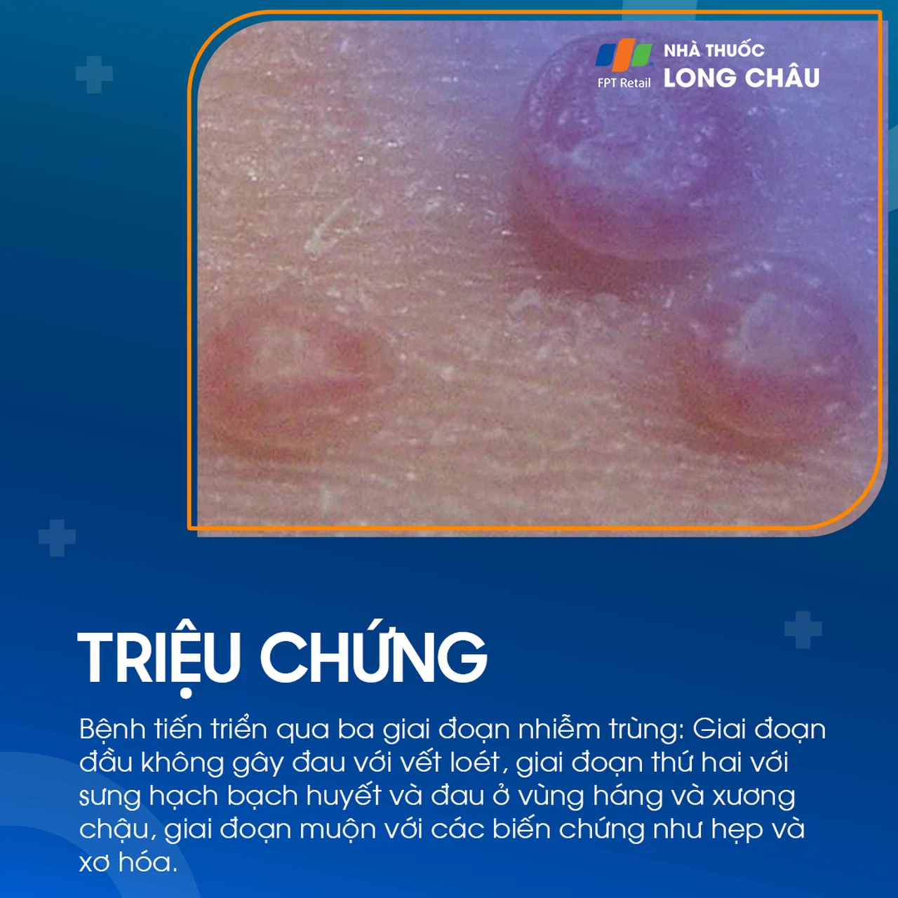 Bệnh hột xoài 3