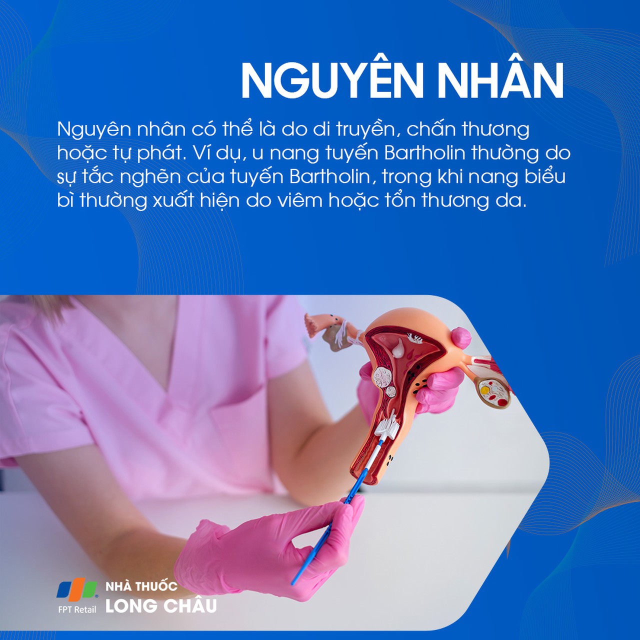 Nang âm hộ 3