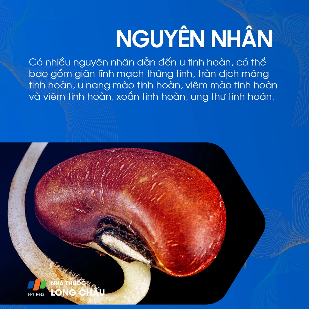 U tinh hoàn 3