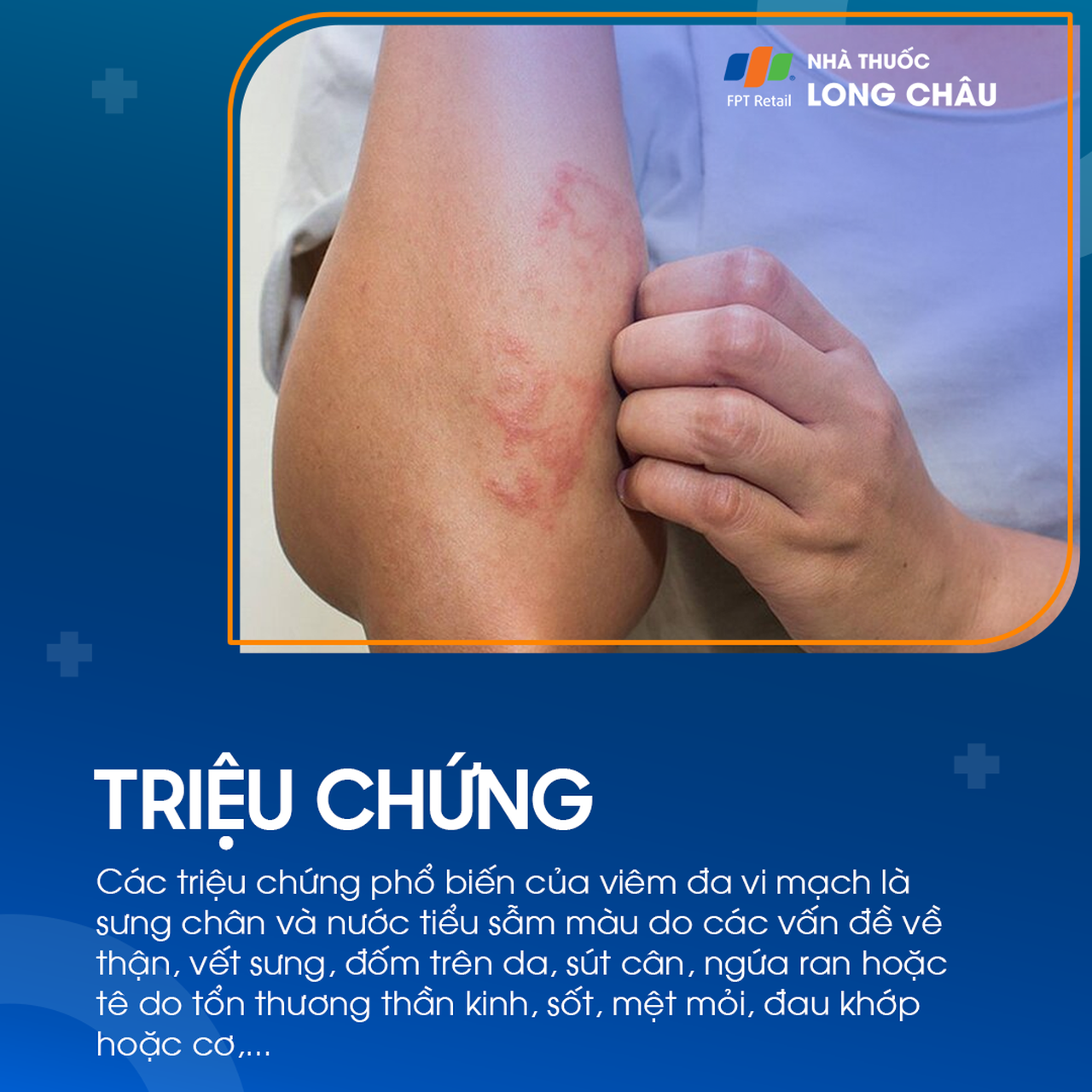 Viêm đa vi mạch 2