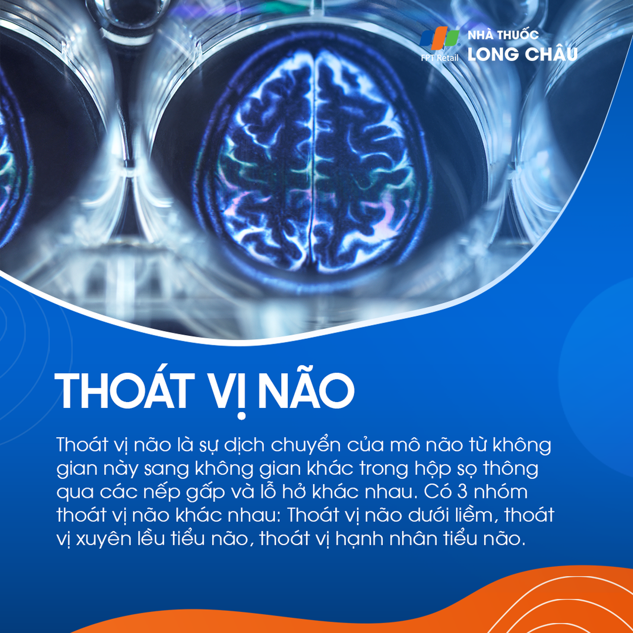 Thoát vị não 1
