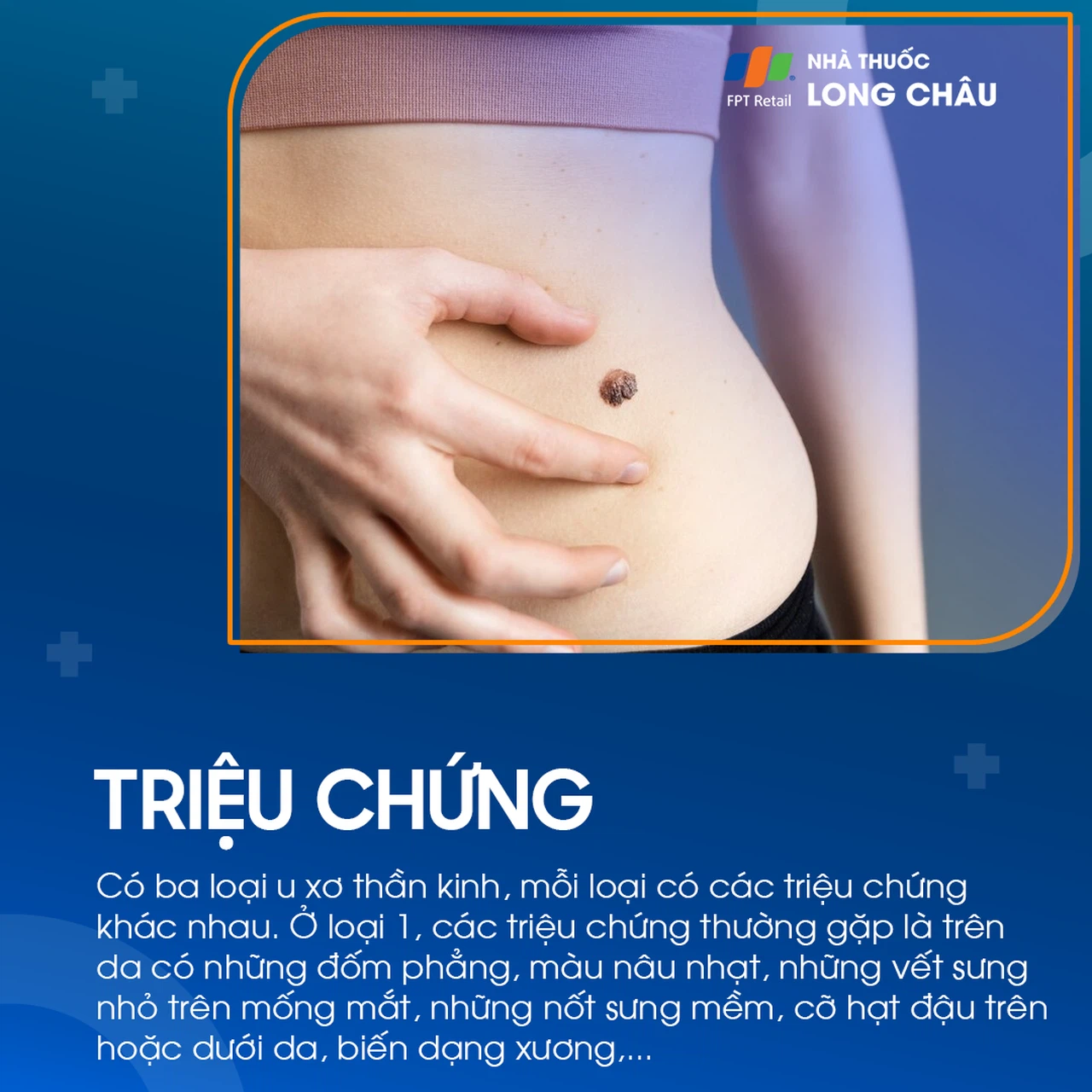 U xơ thần kinh 2