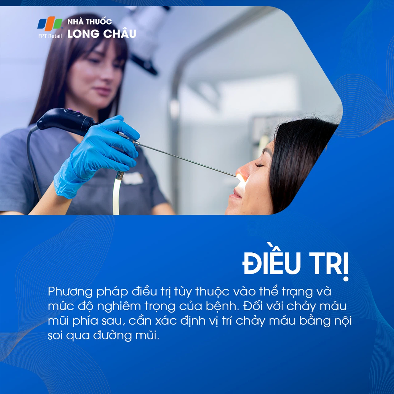 Chảy máu mũi 7