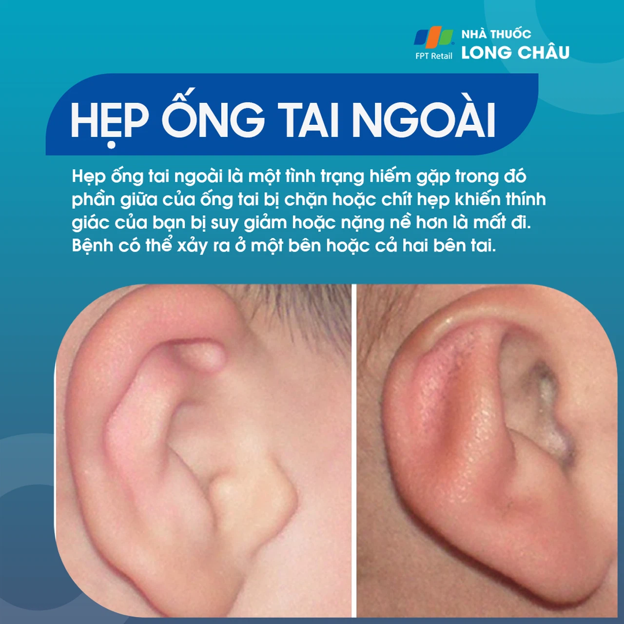 Hẹp ống tai bên ngoài 1