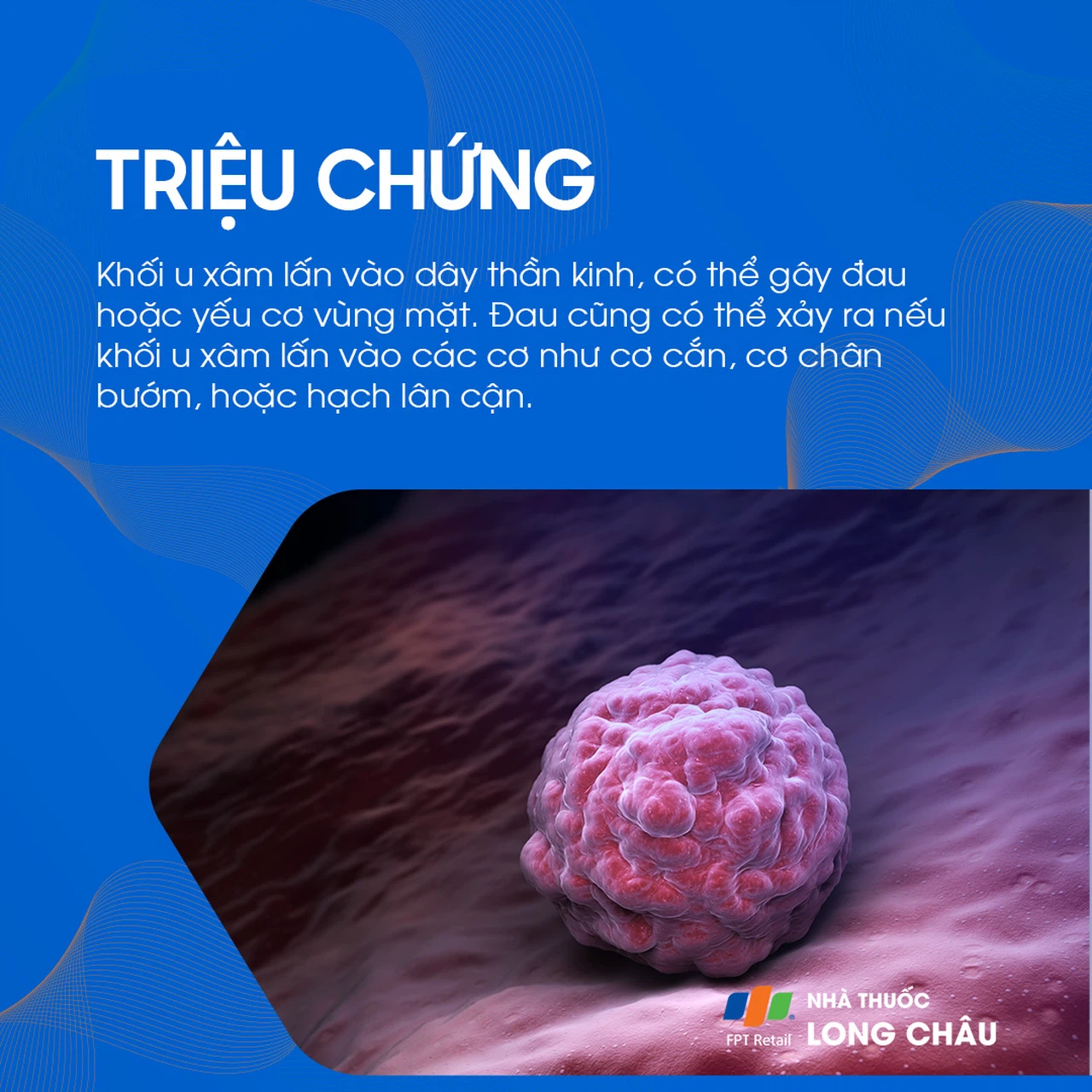 U tuyến nước bọt mang tai 3