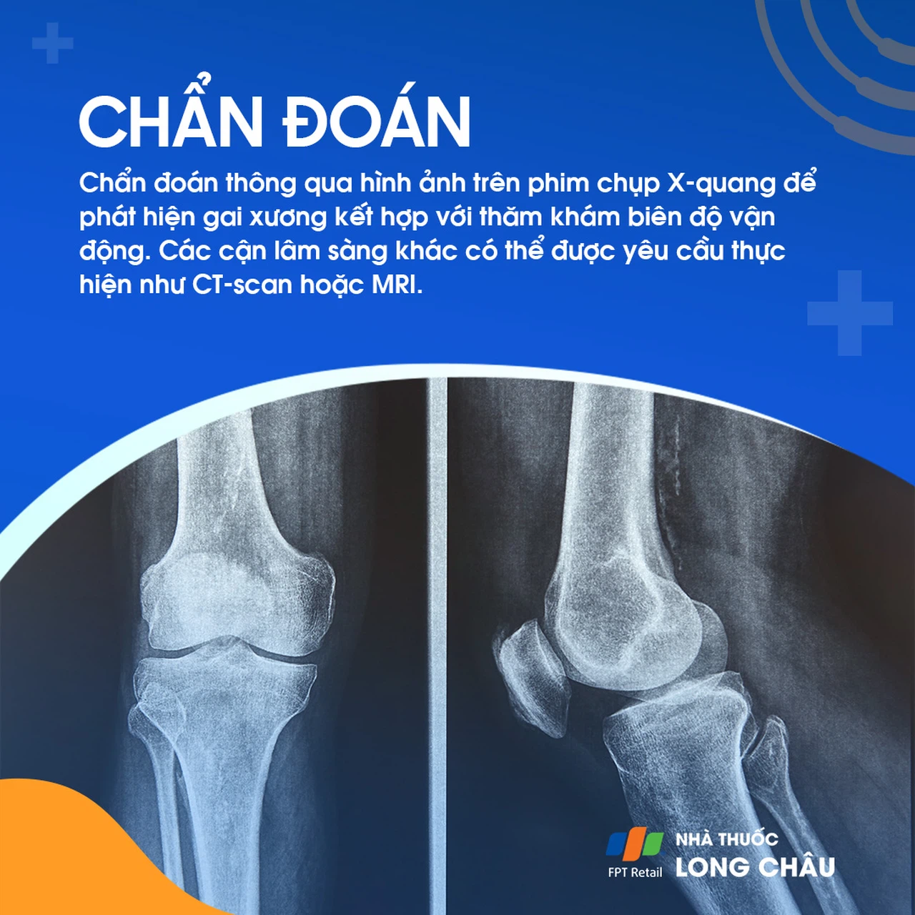 Gai khớp gối 5